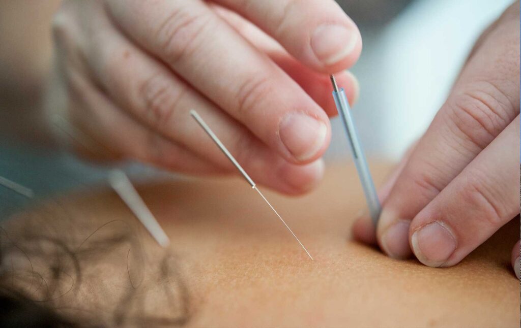 Close up image of hands practicing acupuncture on a patient.